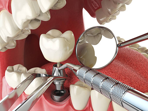 Best Emergency Tooth Extraction in Perry, IA